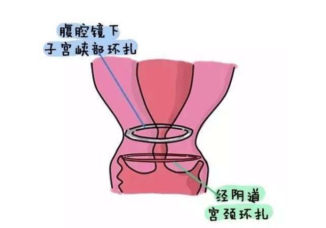 对患者的身心都会造成影响; 还有一种是经腹宫颈环扎术,是在孕14—16