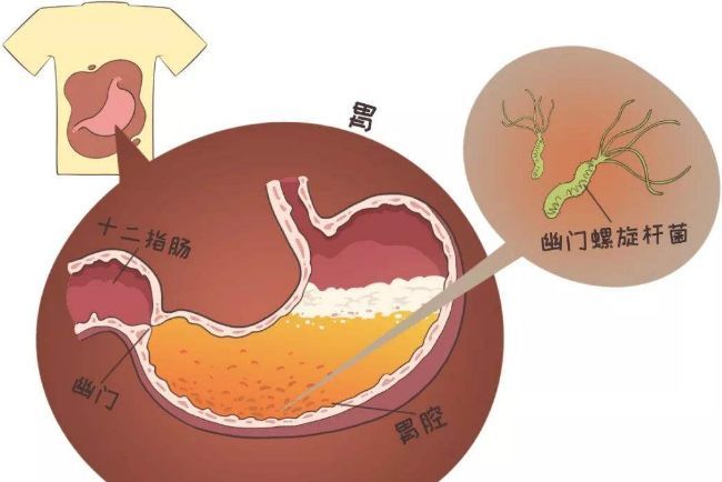 担心自己有幽门螺杆菌?做对这5步能根除有害菌!