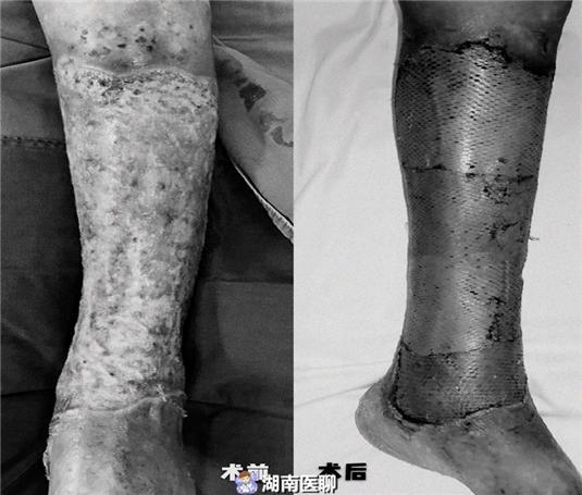 郴州男子土药治腿伤,下肢溃疡一拖20年!