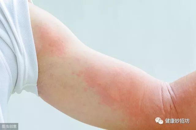 留意:患有荨麻疹不能乱吃,这3类食物少碰