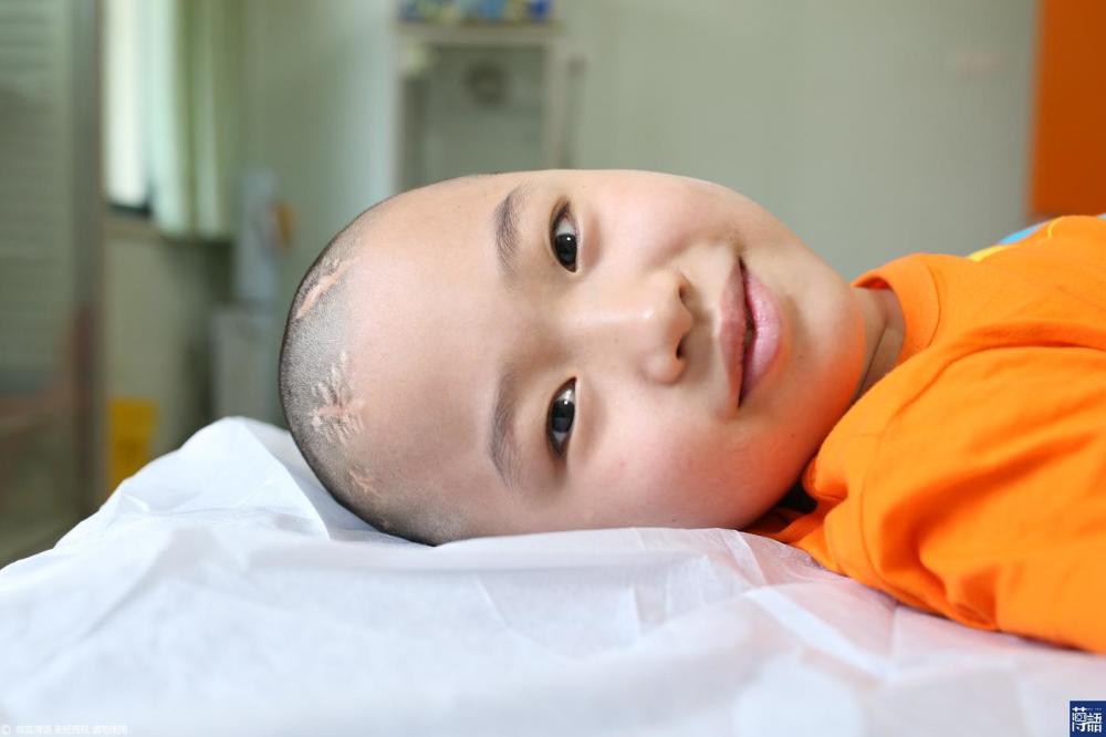 8岁脑积水男孩的生死门:3岁会背三字经,靠4根管子续命