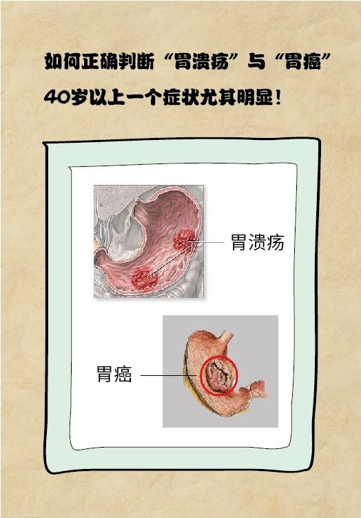 如何正确判断"胃溃疡"与"胃癌",40岁以上一个症