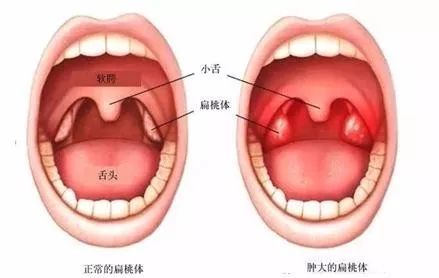 腺样体又称为咽扁桃体,附着于鼻咽顶壁和后壁交界处,两侧咽隐窝之间.