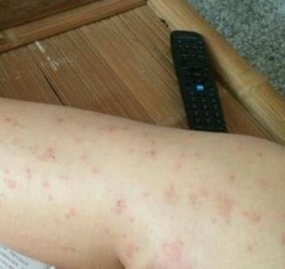 艾滋病,区别,患者,症状,淋巴结