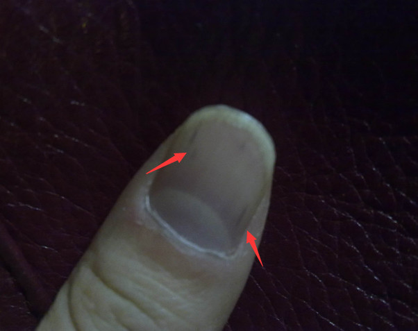 手指甲有黑色竖纹.