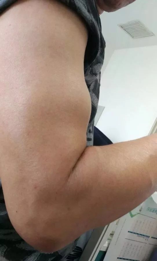 如对功能影响不大,则不必手术;少数症状严重,功能障碍明显者,应手术
