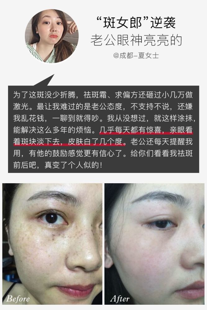 色斑,淡斑,祛斑,黑色素