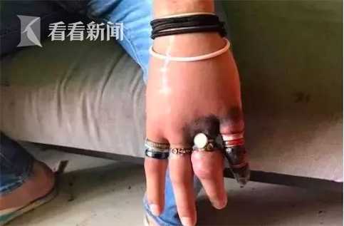 不忍直视!男子戴53枚"戒指 多根手指变形发黑