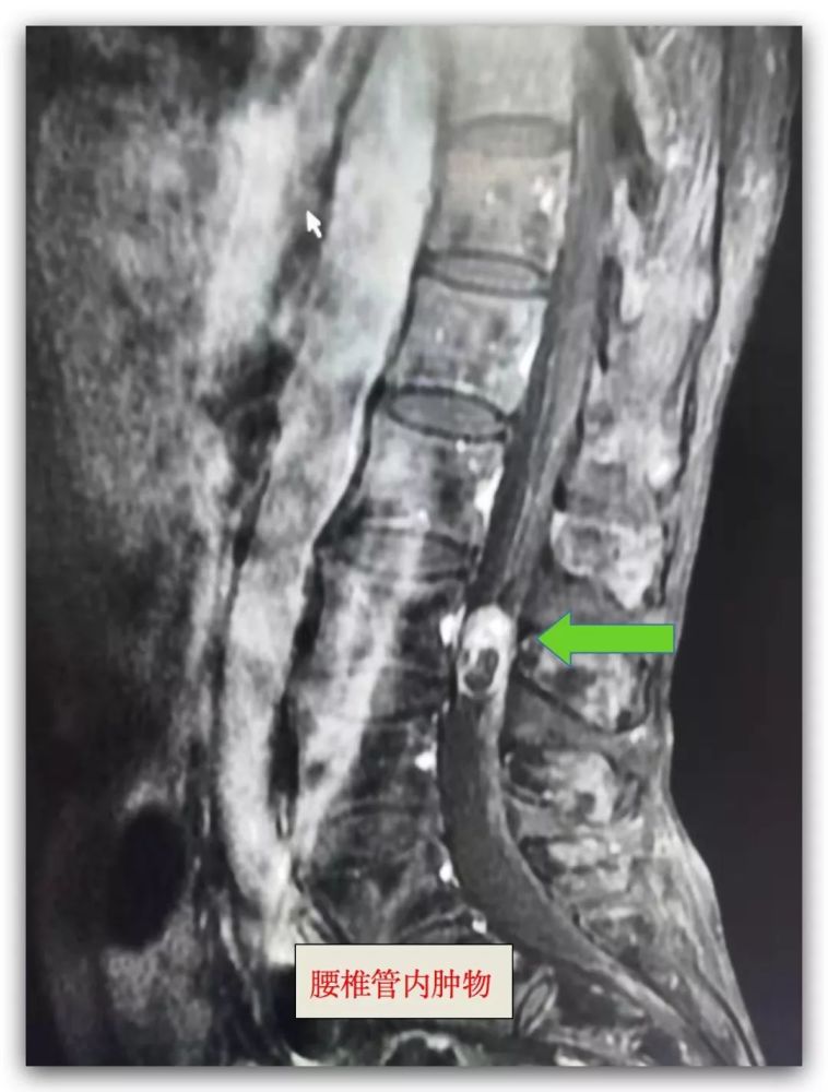 脊柱,腰椎,肿瘤