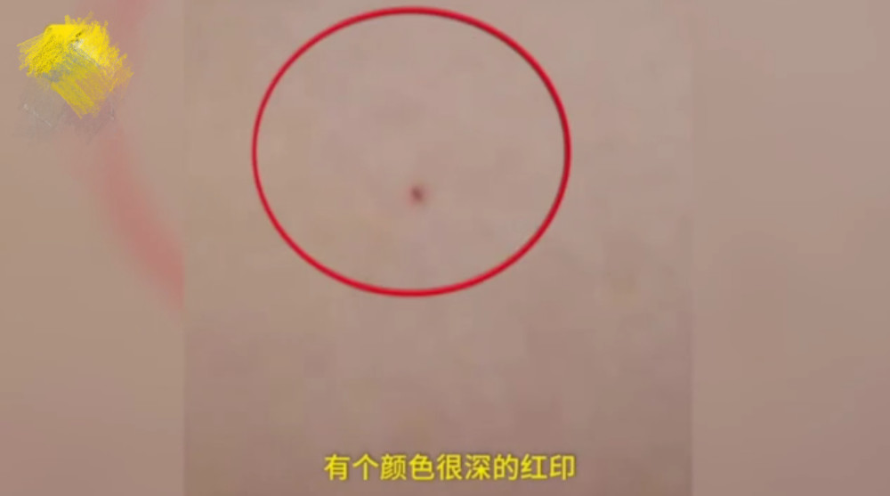 家长投诉女童在幼儿园被针扎大腿,园方却否认,警方已介入调查