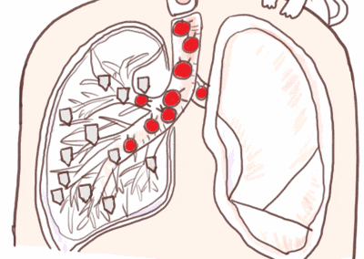 身体一旦出现4种症状,当心是肺癌的预警!