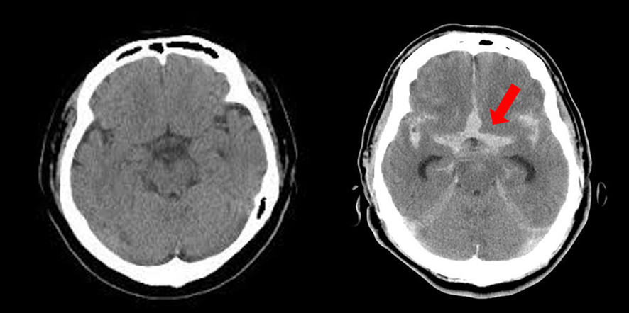 头部ct检查,正常人(左)与蛛网膜下腔出血患者(右),图源:rad-base