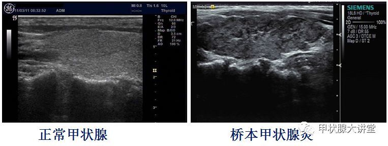 桥本甲状腺炎是什么病?可以是甲亢,也可以是甲减吗?