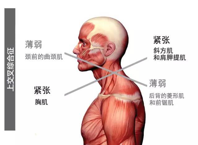 上交叉综合征成因与治疗