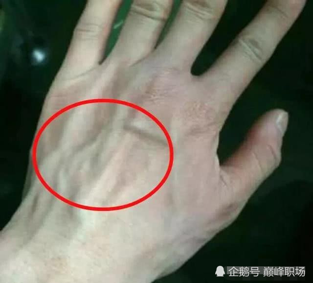 肝不好的人,手上会有6处异常,分别指什么?