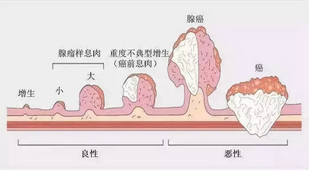 胃炎,胃息肉,胃溃疡的患者为什么要查幽门螺杆菌?