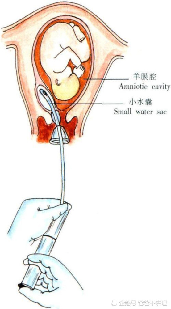 怀孕40周 1,羊水37毫米,医生为什么建议催产?