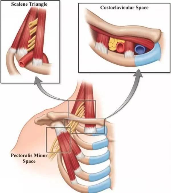 所以臂丛神经容易卡压的地方为前,中斜角肌间隙,肋锁间隙以及胸小肌