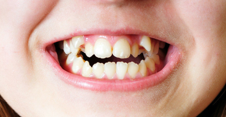若乳牙早失,旁边乳牙倾斜或恒牙萌出时期过早,造成牙列拥挤错位,就算