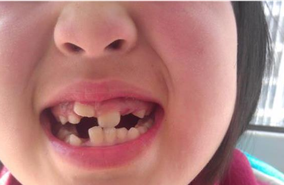 孩子,牙齿,乳牙,育儿,换牙