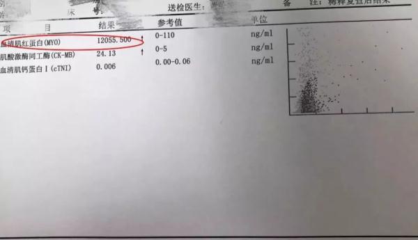 健身,尿液,横纹肌溶解症,山东大学齐鲁医院