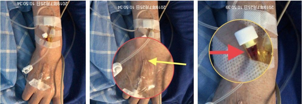 留置针维护又现新问题?5大固定要点不可不知!