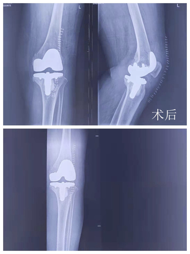 烟台七旬老人行"僵硬膝"复杂膝关节置换手术