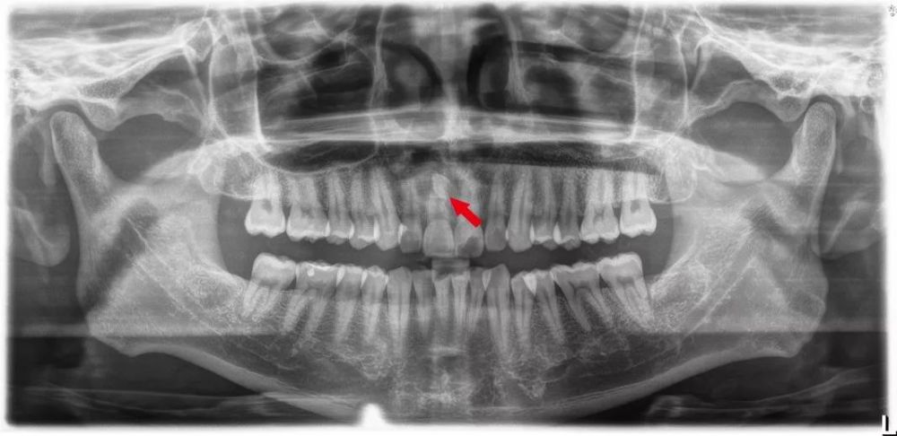 囊肿(如下图)等,不但会影响牙齿的移动,其本身也是需要处理的健康问题