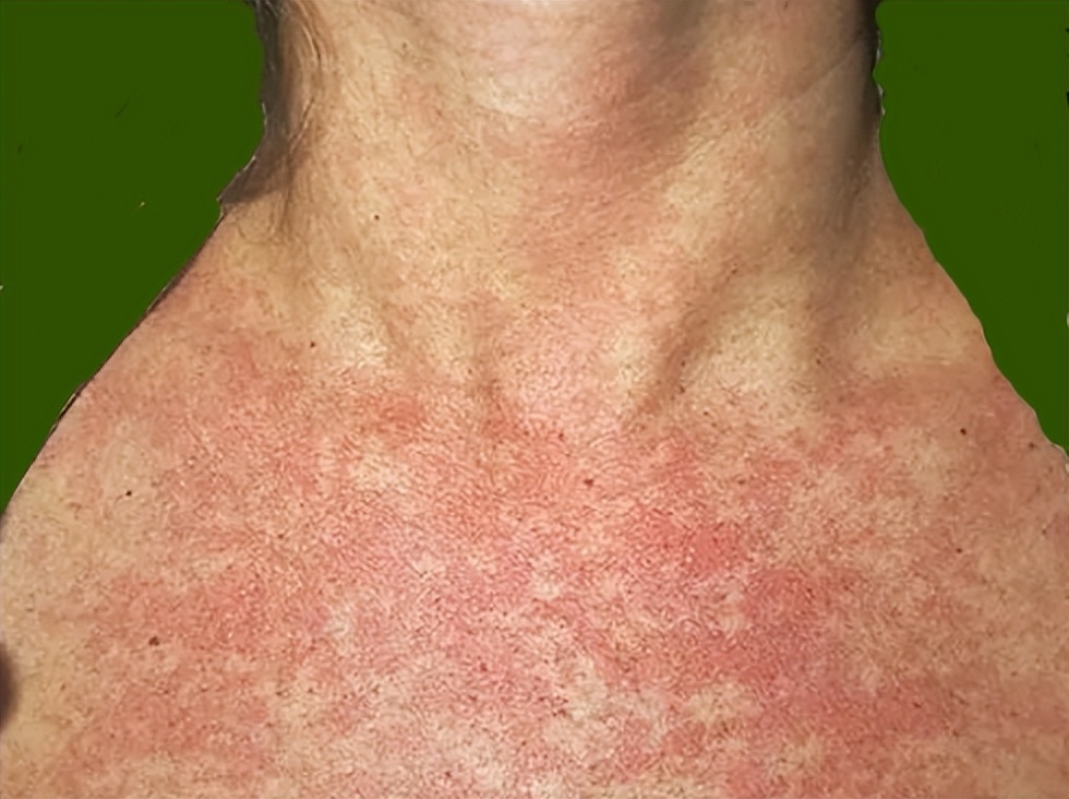 隐隐约约记得,好像有资料描述过一种意外情况叫做"红人综合征".