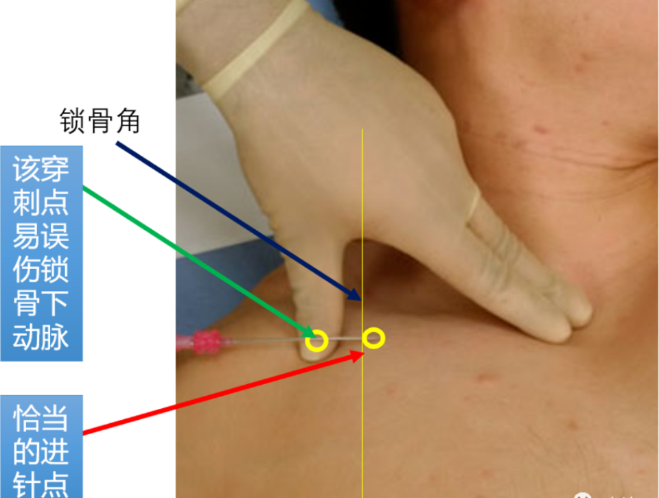 导丝怎么扩规培临床技能：中心静脉置管术全攻略之超声引导下锁骨下静脉穿刺置管术（8）_https://www.jmylbn.com_新闻资讯_第2张
