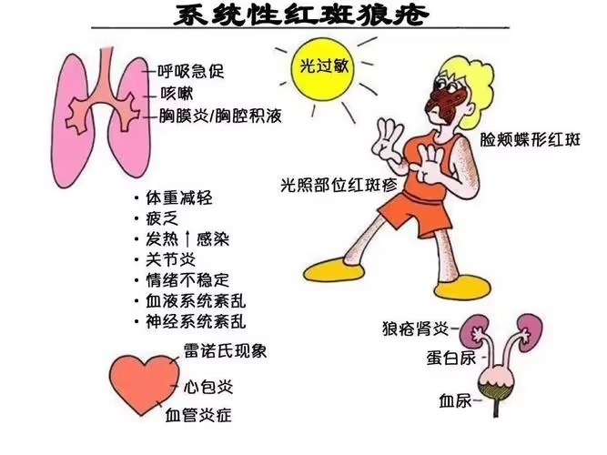 女子晒太阳患"不死的癌症":红斑狼疮为何如此厉害?如何预防?-腾讯新闻