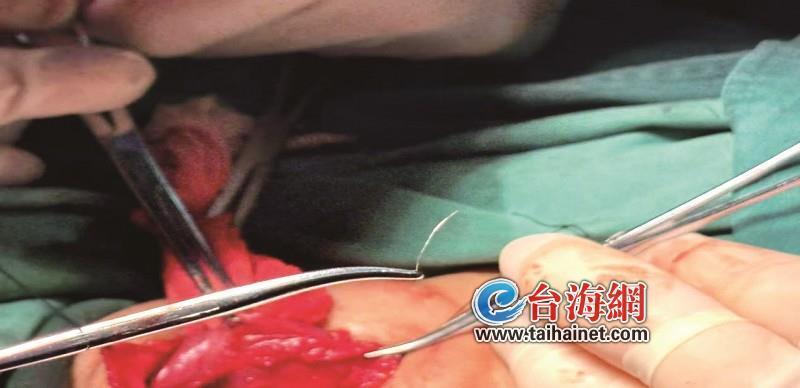 70多岁阿婆咽痛难忍，病因竟是误吞钢丝球碎片？医生紧急施救