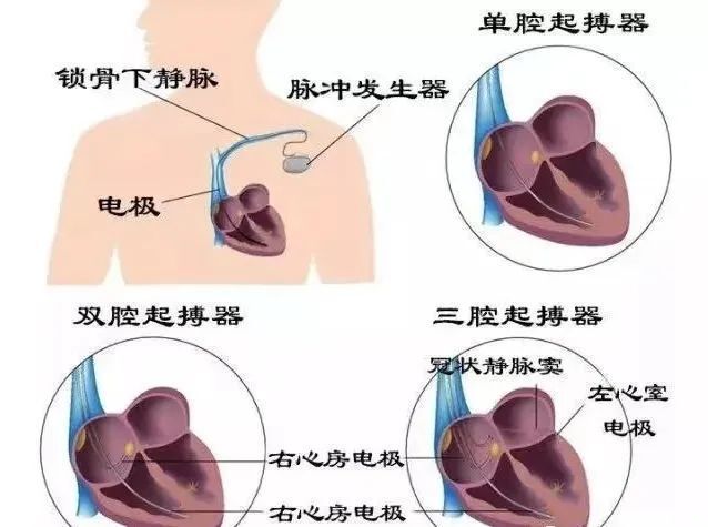 心脏起搏器多大图片图片