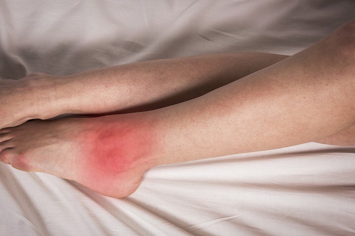 一到夏天就招虫咬?皮肤科医生教你防蚊妙招