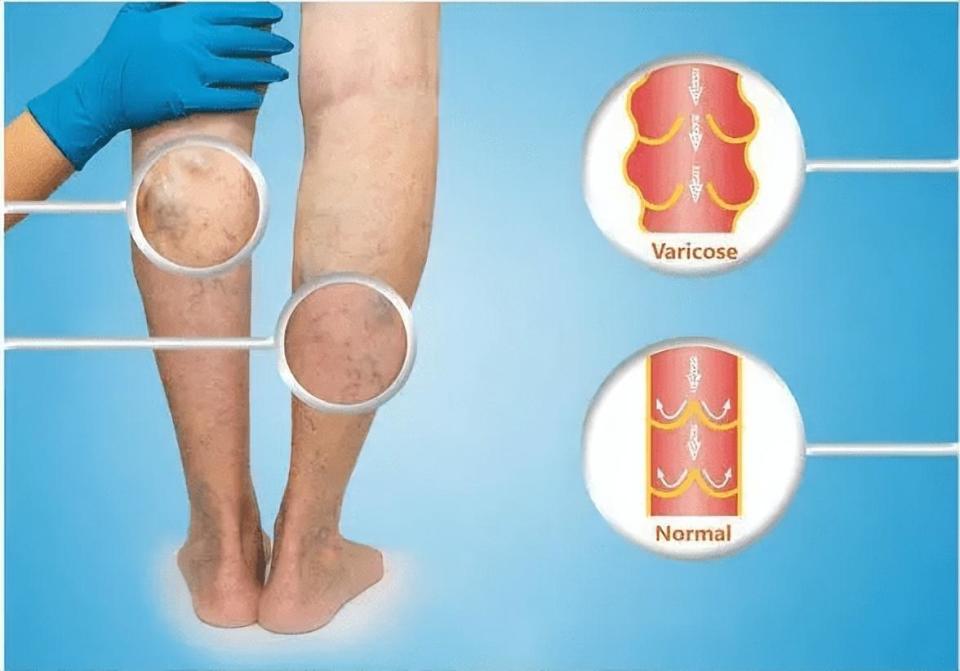 隐形杀手下肢静脉血栓三大元凶作祟出现这些信号要注意