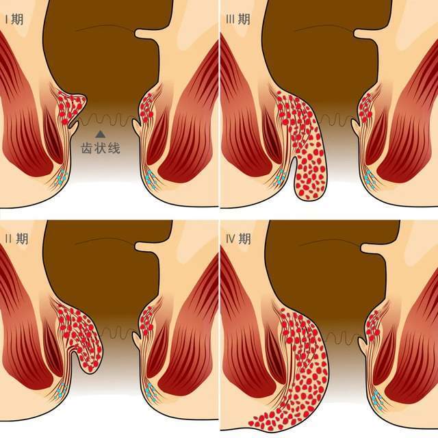 中国哪个省,痔疮比例最高? | 地球知识局