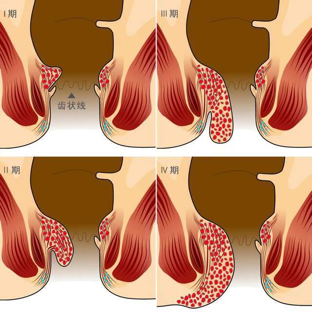 图注:不同时期痔疮的状态痔疮的症状包括出血,疼痛,瘙痒,粪便渗漏