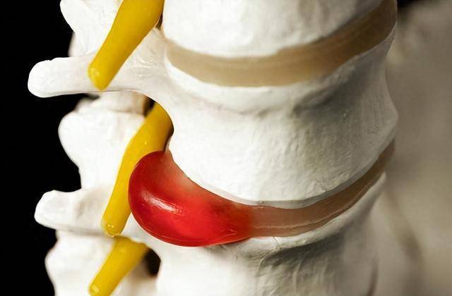 腰椎间盘突出到底怎么回事