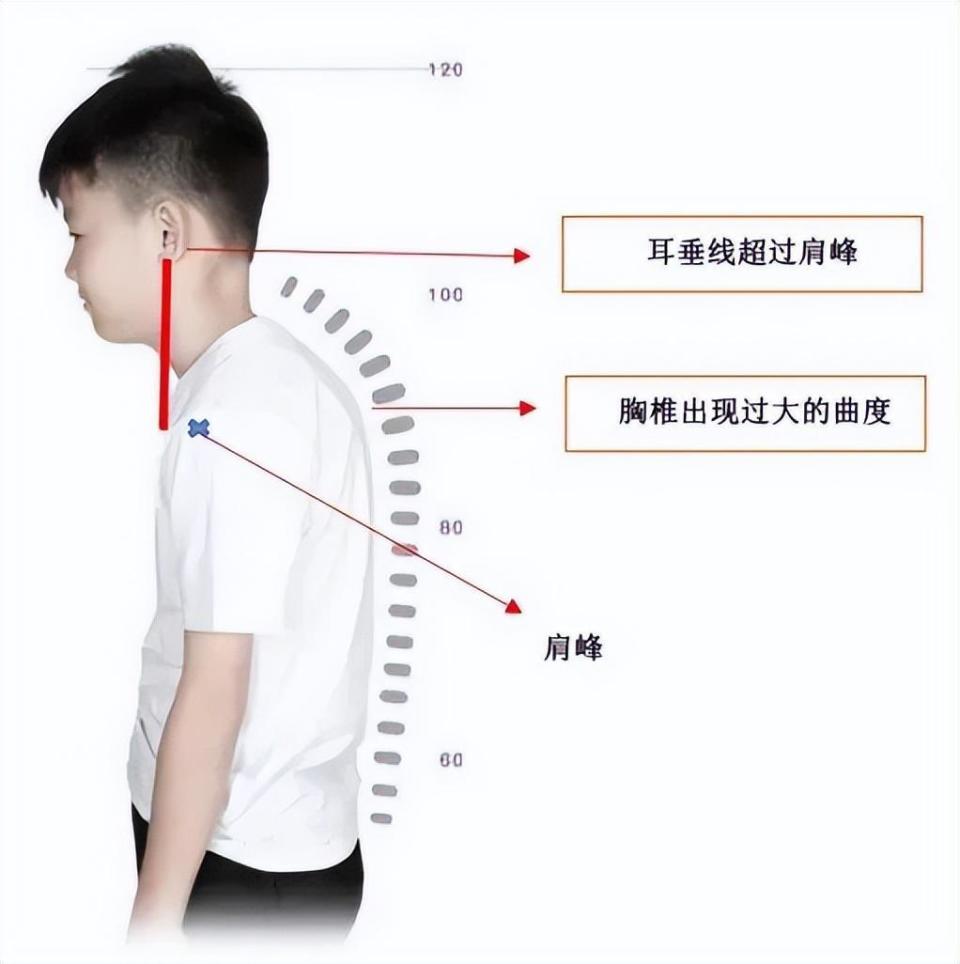 驼背分为几种图片图片