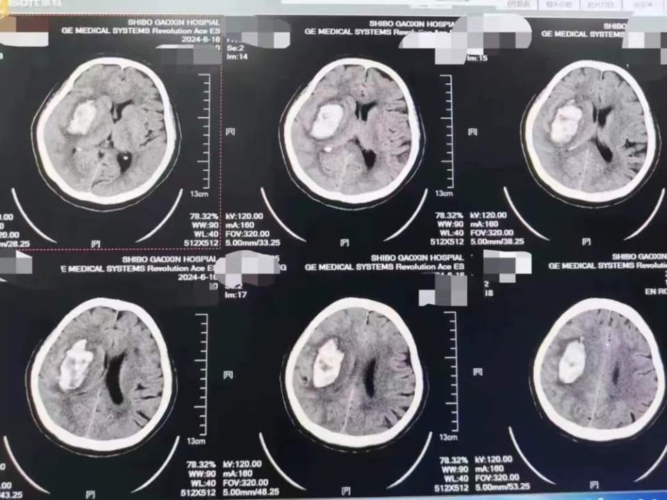 于急诊出现了恶心呕吐的症状,进行颅脑ct检查结果脑出血,出血量高达