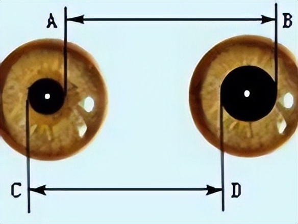 双侧瞳孔不等大图片图片