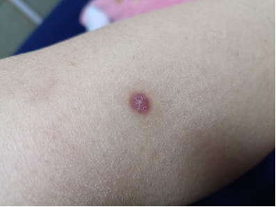 被虫子叮咬后持续发热,浑身酸痛?你有可能患上"恙虫病"了!