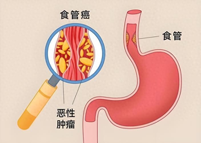 一口热汤腌菜竟悄悄摧毁食管？食管癌元凶大
