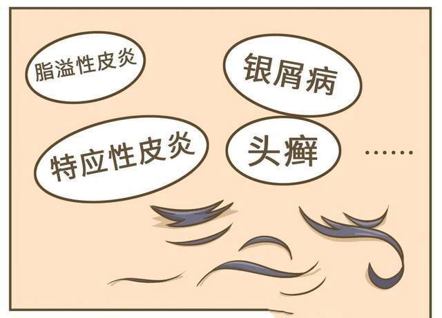 油头、油脸、油脖子？可能脂溢性皮炎作怪，科学护理不踩坑_腾讯新闻