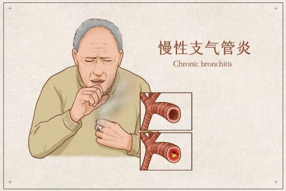 遠離慢性支氣管炎,這些錯誤認知不要犯!做好正確治療!