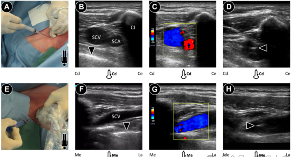 导丝怎么扩规培临床技能：中心静脉置管术全攻略之超声引导下锁骨下静脉穿刺置管术（8）_https://www.jmylbn.com_新闻资讯_第3张