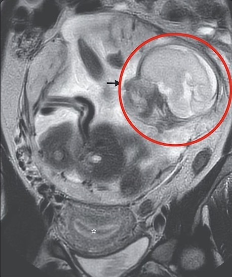 磁共振检查胎儿男女图图片