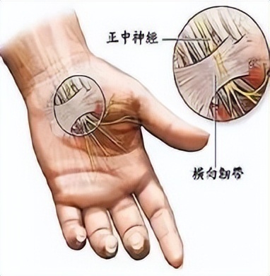 腕关节关节腔注射图片