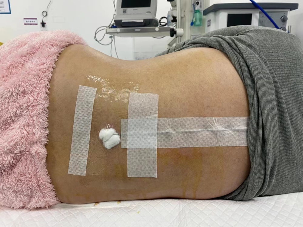 分娩镇痛在顺转剖宫产术中的重要性