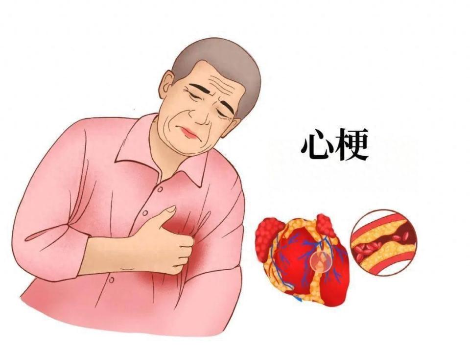 心肌梗塞,又称心肌梗死,是一种由于冠状动脉血供急剧减少或中断,导致